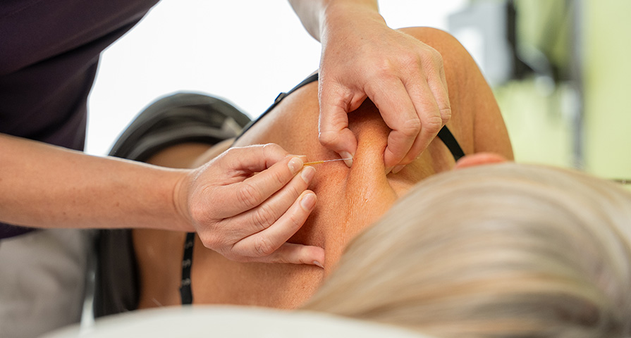 Dry Needling: Mit einer sterilen Einwegnadel werden myofasziale Triggerpunkte in der Muskulatur behandelt.